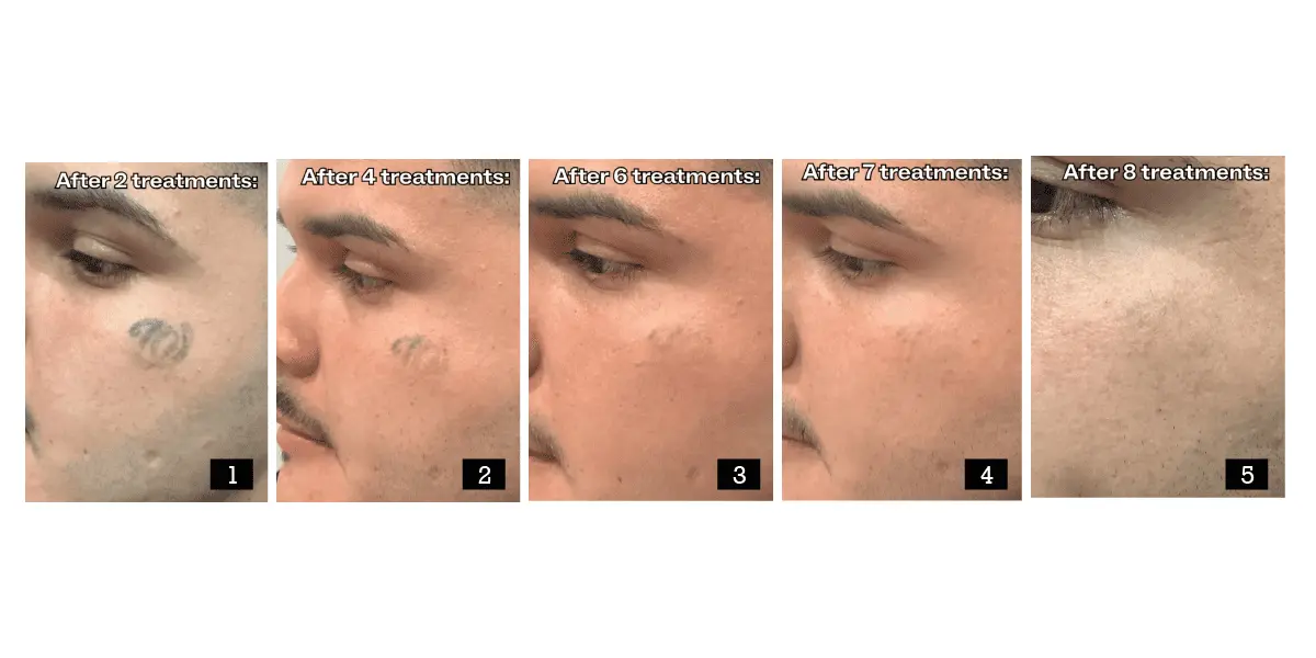 Tattoo Removal Before and After — What Results Actually Look Like 2026