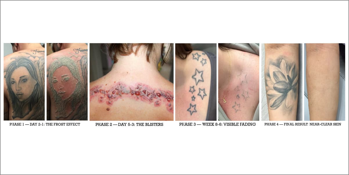Tattoo Removal — What Each Phase Actually Looks Like