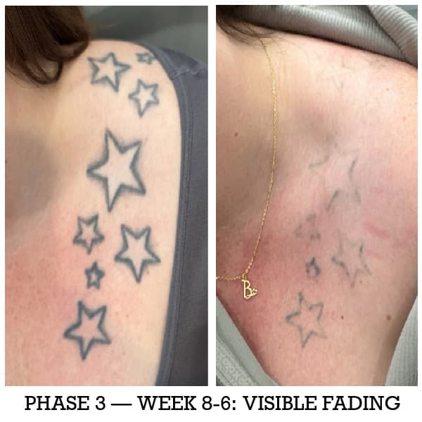 Week 6-8 tattoo removal visible fading ink lightening