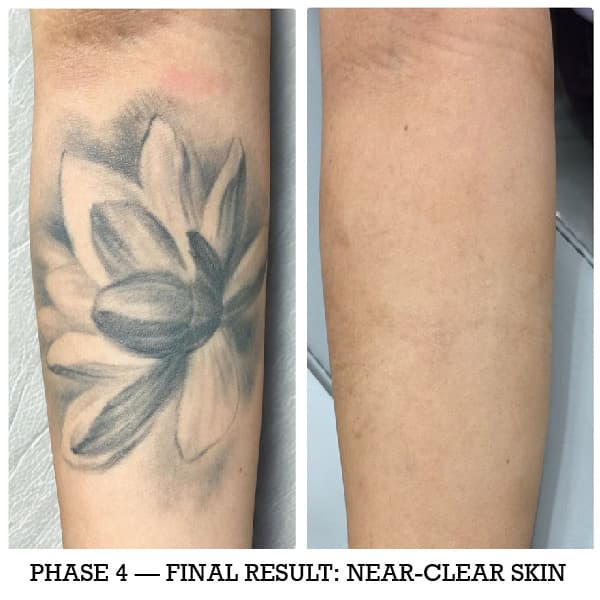 Final tattoo removal result near-clear skin faint ghost shadow
