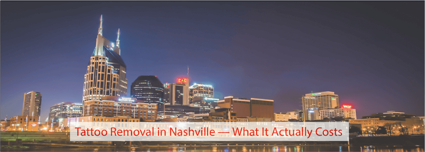 Tattoo Removal in Nashville — What It Actually Costs